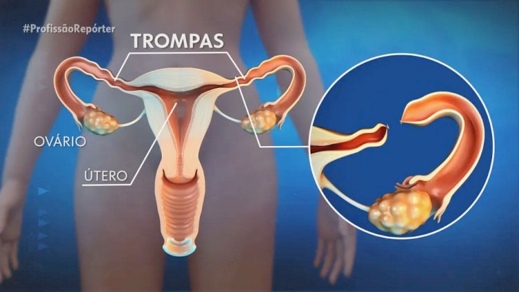 STF julga legalidade de lei que restringe laqueadura e vasectomia